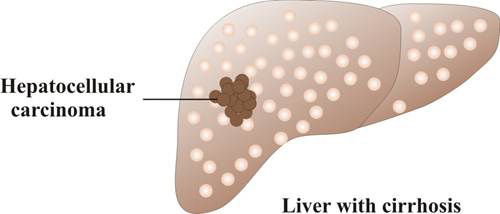 Hepatocellular Carcinoma